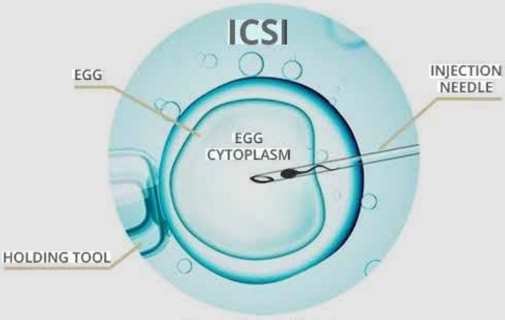 ICSI treatment in Laxmi Nagar