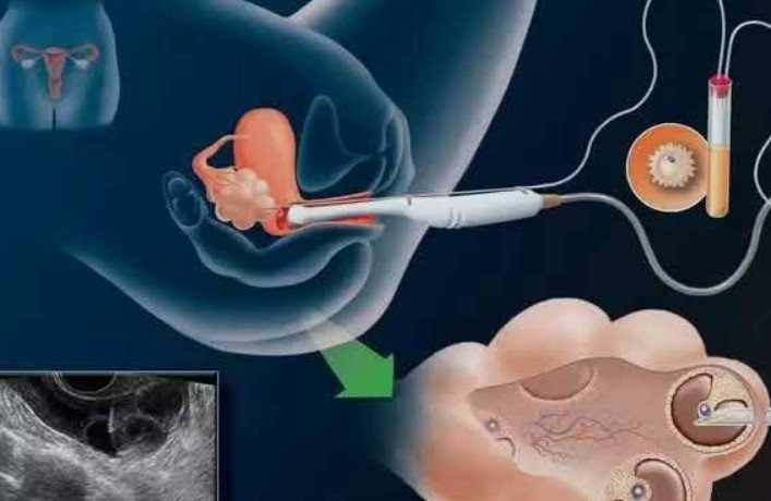 Egg Donation Centre in Laxmi Nagar