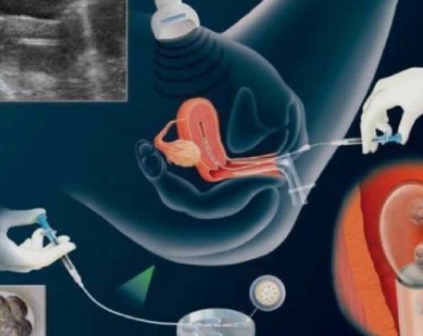 Female Infertility Evaluation Treatment in Mayur Vihar