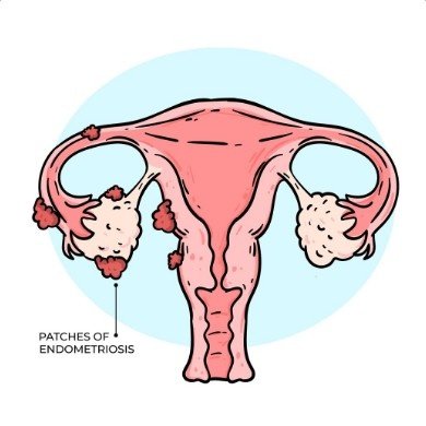 Endometriosis Doctor in East Delhi