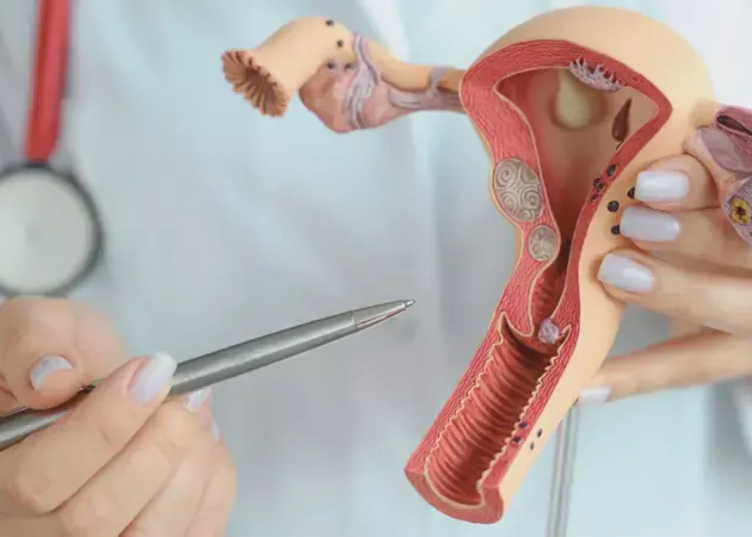 750x450_247380-endometrial-polyps